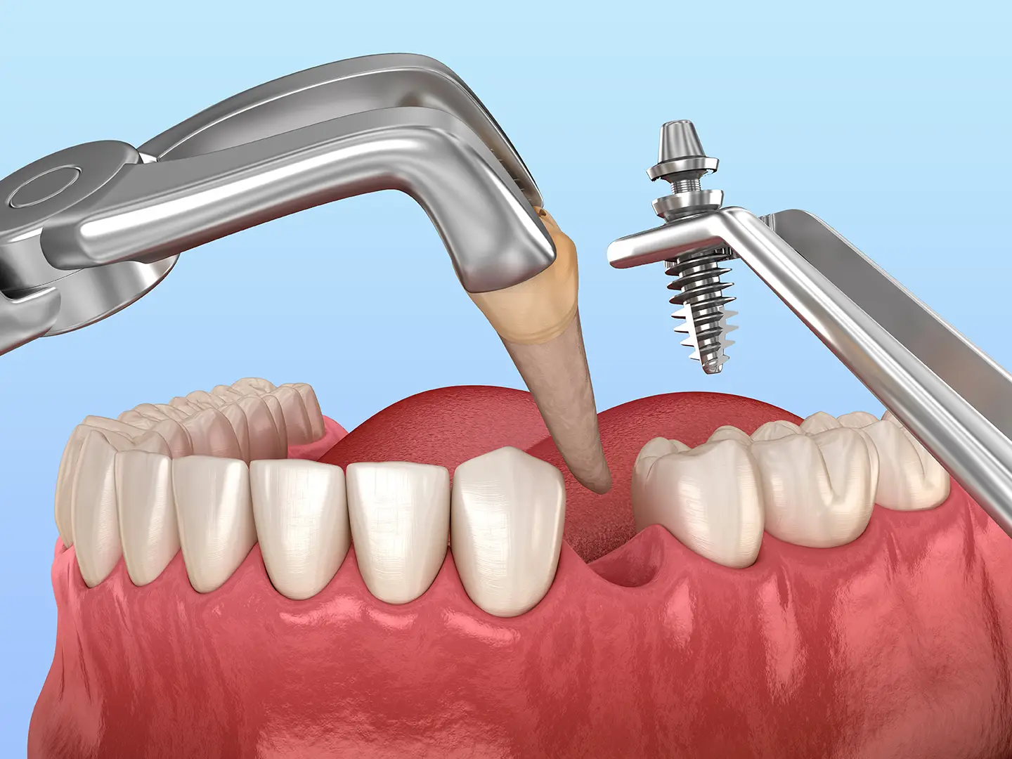 Ankara İmmediat İmplant diş çekiminden sonra anında implant fiyatları
